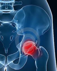 Wright Profemur Hip Replacement: Adverse events